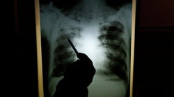 In The Age Of Travel, Tuberculosis Knows No