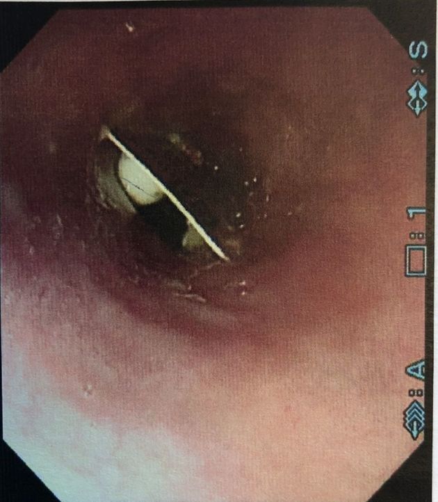 An image of the pill packet that was lodged down a Northern Ireland woman’s throat for almost three weeks