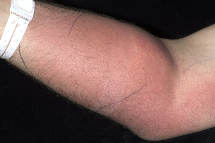 Cellulitis and edema of the man's right forearm.