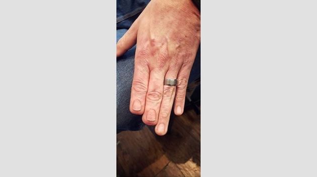 Απέκτησε ξανά τα δάχτυλά του μέσω... τατουάζ -Το αποτέλεσμα είναι εκπληκτικό (εικόνα)