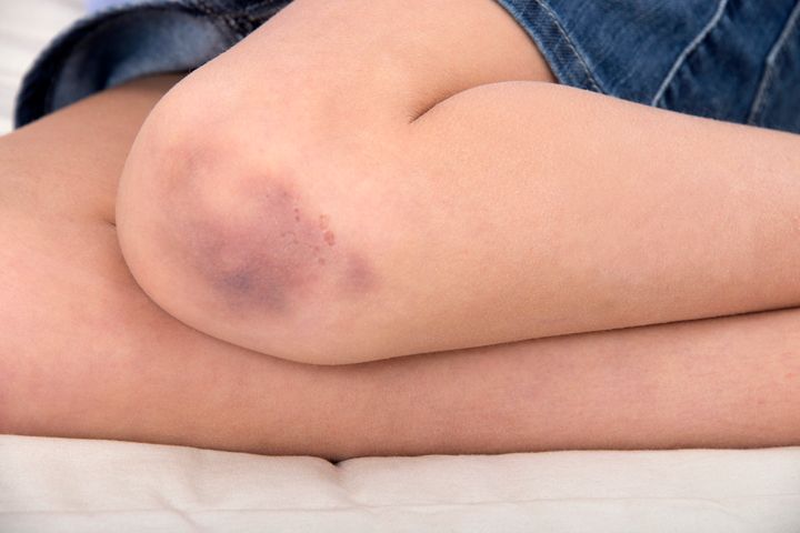 Experts say there a few common reasons why you might bruise more easily than others.