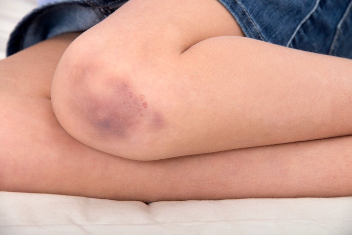 can your body bruise easly while on diet