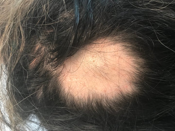 Wong's first bald spot, found in February 2018, was a shock to her.