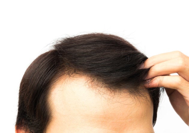 Why am I losing hair at a young age?