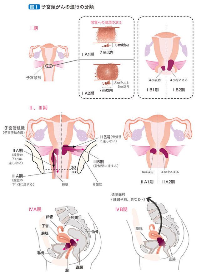 患者さんとご家族のための子宮頸がん 子宮体がん 卵巣がん 治療ガイドライン 第2版 日本婦人科腫瘍学会編集 （金原出版株式会社）