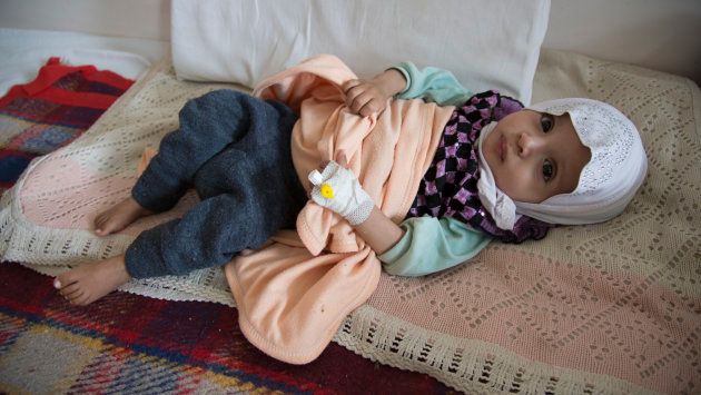 急性の栄養不良と診断されたイエメンの子ども