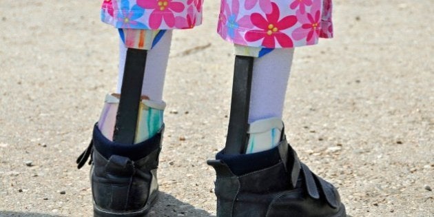 (GERMANY OUT) handicapped girl with artificial legs - 2008 (Photo by JOKER/Walter G. AllgÃ¶wer/ullstein bild via Getty Images)