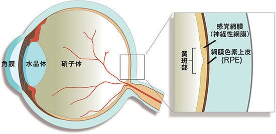 Ips細胞の移植 1年後も経過良好 世界初の網膜手術 ハフポスト