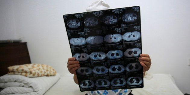 Huang shows her CT scan film in her room at the accommodation where patients and their family members stay while seeking medical treatments in Beijing, China, June 22, 2016. Huang, who suffers from rectal cancer, came from Inner Mongolia to seek treatment in a hospital in Beijing. REUTERS/Kim Kyung-Hoon SEARCH