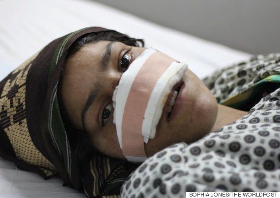 北部マザリシャリフの病院のベッドで1月24日、夫からの数々の暴行の中でも最悪の被害を受け、治療を受けるリザガル。海外で鼻の再構築手術を受けることを望んでいる。