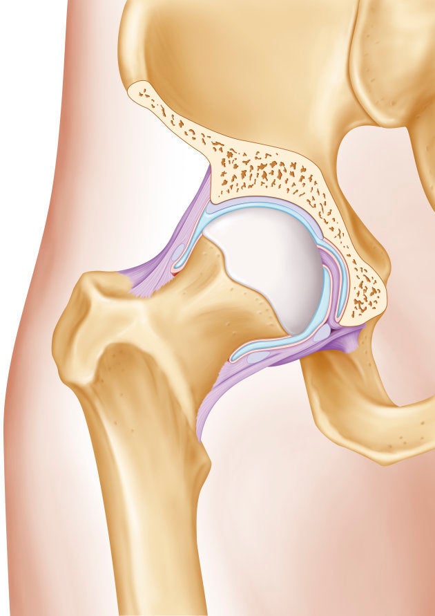 股関節に組み込まれたボール状の骨。これが大腿骨頭だ。この部分に血が巡らなくなり、壊死して骨が崩れたときに、痛みが生じる