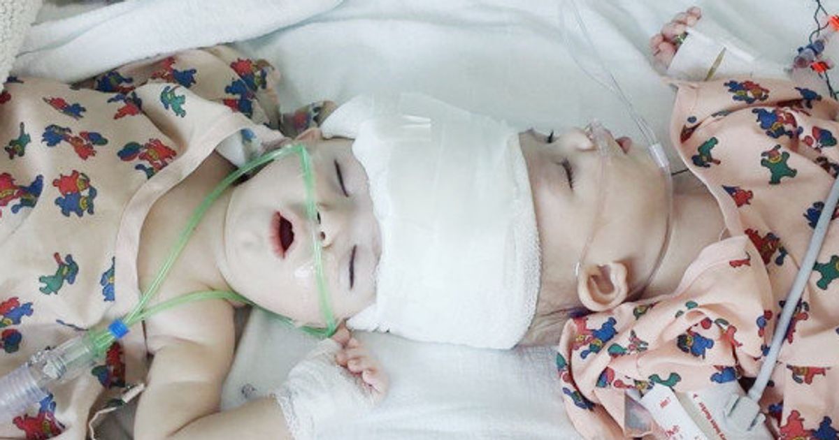 きょうが二度目の誕生日だね 頭部が結合した双子の赤ちゃん 分離手術が無事成功 ハフポスト