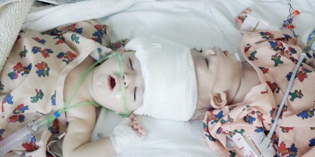 きょうが二度目の誕生日だね 頭部が結合した双子の赤ちゃん 分離手術が無事成功 ハフポスト きょうが二度目の誕生日だね 頭部が結合した双子の赤ちゃん 分離手術が無事成功 ハフポスト