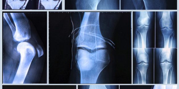 Knee X-ray and MRI befor and after arthroscopic surgery for Anterior cruciate ligament injury