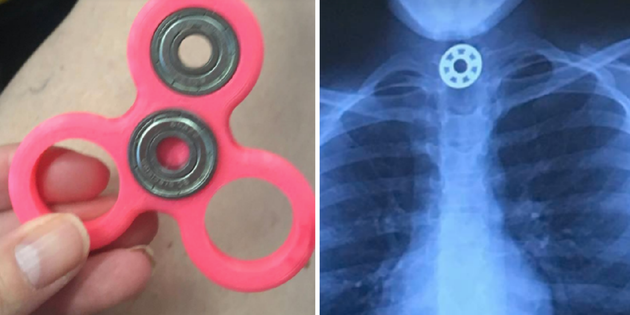 人気おもちゃ フィジェットスピナー に潜む危険 10歳児の喉に部品が詰まる ハフポスト 人気おもちゃ フィジェットスピナー に潜む危険 10歳児の喉に部品が詰まる ハフポスト