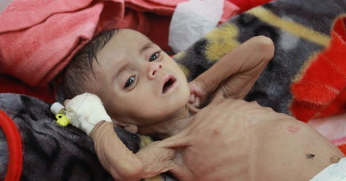 中東イエメンでは 5歳未満の子供が10分おきに死んでいる 世界最大規模の人道危機だ ハフポスト