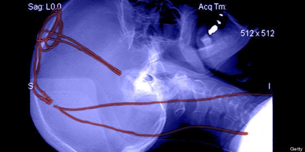 This lateral (from the side) xray demonstrates 2 deep electrodes (red) extending through 2 frontal burr holes and extending deeply into the cerebral hemispheres bilaterally for the treatment of Parkinson's disease. These electrodes are for Deep Brain Stimu