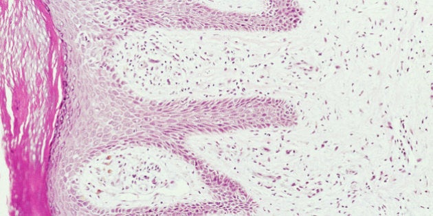 Light micrograph of a skin section of a patient suffering from chronic dermatitis. Chronic dermatitis (or eczema) refers to a longstanding irritable area.