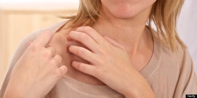 Woman scratching rash. (Photo by: Media for Medical/UIG via Getty Images)