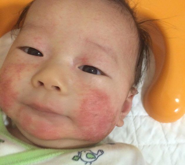 アレルギーで発疹が目立つ赤ちゃん