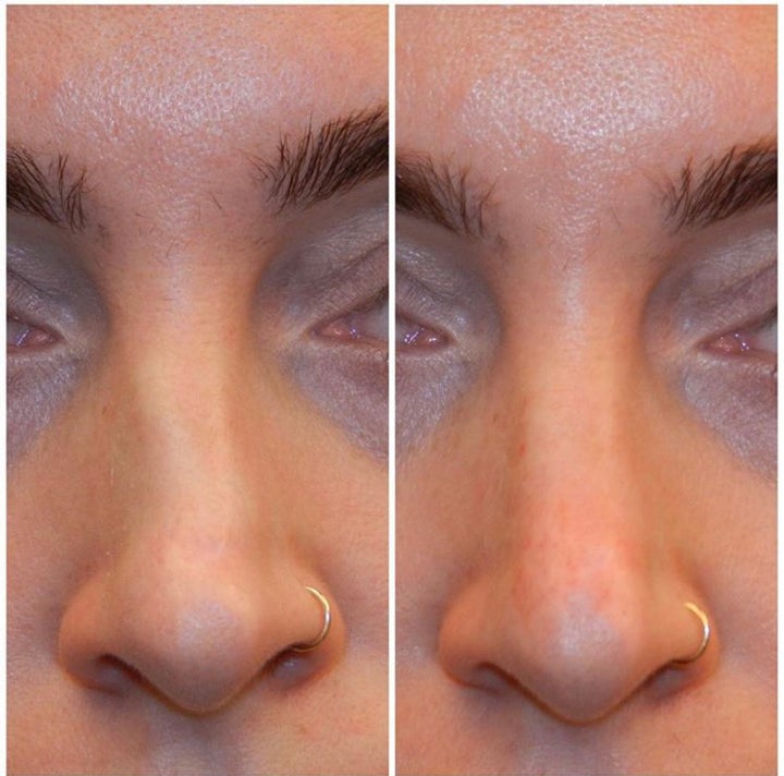 liquid-nose-jobs-everything-to-know-about-nonsurgical-rhinoplasty