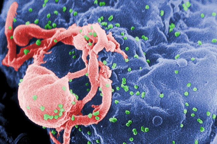 A scanning electron micrograph of multiple round bumps of the HIV-1 virus on a cell surface.
