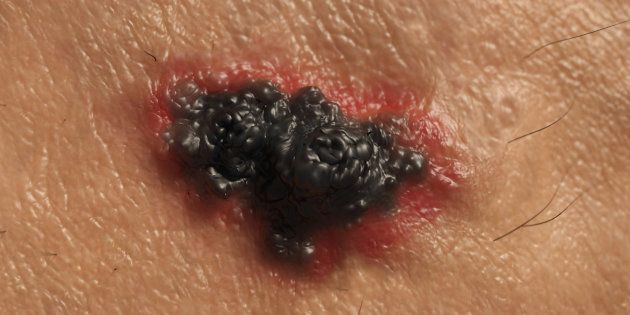 melanoma-get-any-unusual-bumps-or-lumps-checked-huffpost-uk