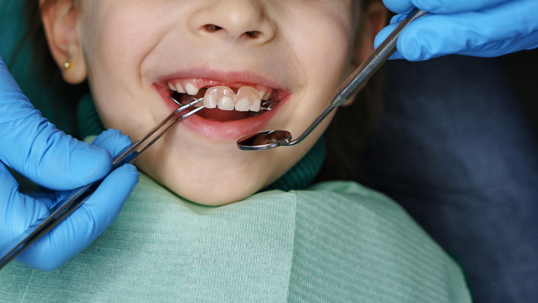 Kids Under Five Are Having Rotting Teeth Extracted - But ...