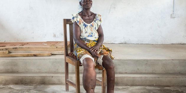 02/04/2014. Asemkow village, Ahanta West district, Ghana. Patient Aba Kosoh, 61 years old, showing lymphedema (swelling) of the leg. DNDi/Cosmos/Sylvain Cherkaoui