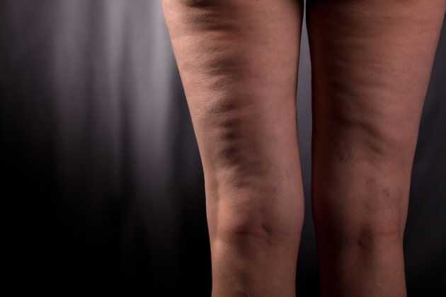 Having cellulite doesn't mean you're unhealthy.