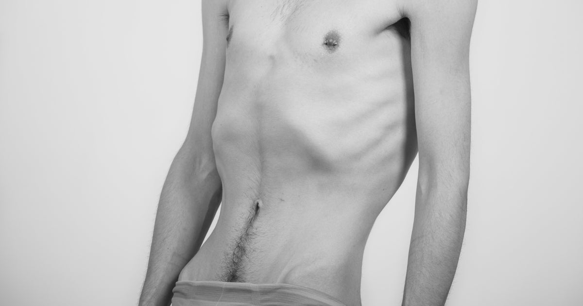 Magersüchtige Mädchen