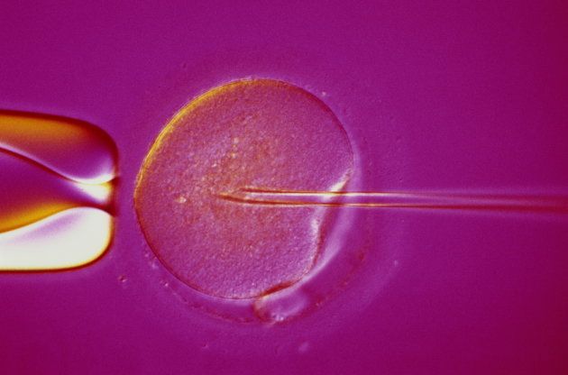 Under micrograph: A single sperm is injected into the cytoplasm of an egg, via a microneedle.