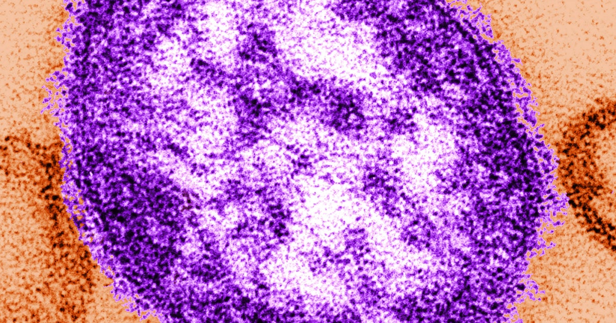 Man Charged After Allegedly Breaking Measles Quarantine To Go To Gym