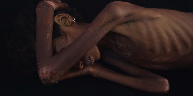 Una niña desnutrida en Yemen.
