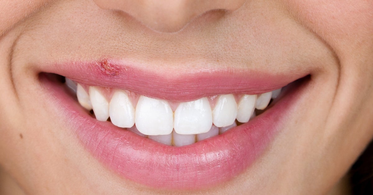 remedio casero contra herpes bucal