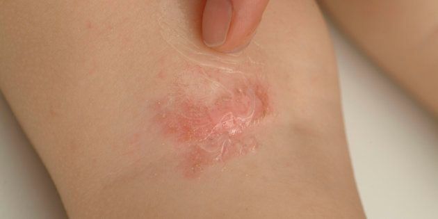 Dermatitis 11 preguntas (y respuestas) sobre esta enfermedad | El HuffPost Tendencias