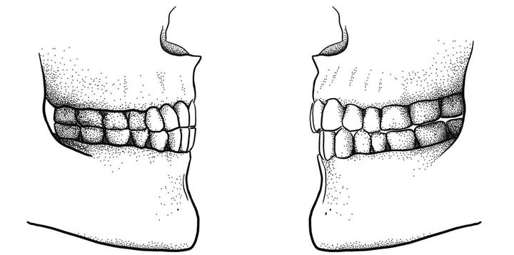 The difference between a Paleolithic edge-to-edge bite (left) and a modern overbite/overjet bite (right).