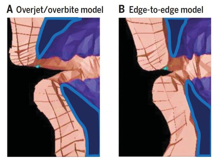 Biomechanical model of producing an ‘f’ sound with an overbite/overjet (left) versus an edge-to-edge bite (right). 