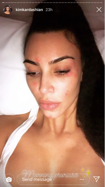 Kim Kardashian shared a candid photo of her skin condition on Sunday.