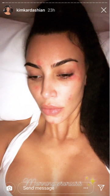 Kim Kardashian Shows Off Psoriasis On Her Face In Candid Photo