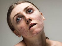 Pour accepter son acné, cette mannequin a lancé la campagne #FreeThePimple et libère la parole | Le Huffington Post LIFE