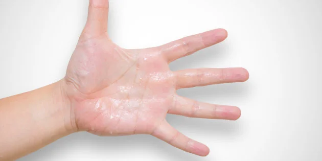 J Ai Les Mains Et Les Pieds Moites Ca N Est Pas Drole Au Quotidien Mais J Ai Decide De Bien Le Vivre Le Huffington Post Life