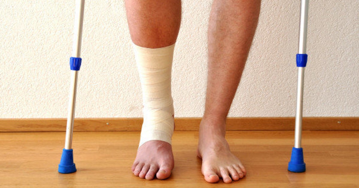 Comment Consolider Une Fracture Rapidement Homeopathie Comment guérir d'une fracture | Le Huffington Post
