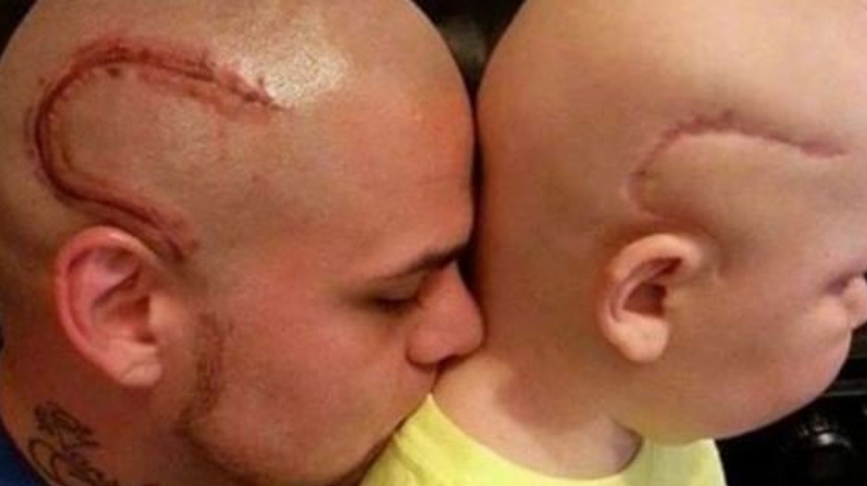 Ce Papa Se Fait Tatouer Une Cicatrice Identique A Celle De Son Fils Opere Du Cerveau Le Huffington Post Life