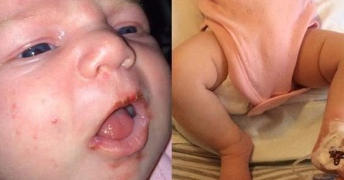 Une Maman Alerte Sur Les Dangers De L Herpes Pour Les Bebes Le Huffpost