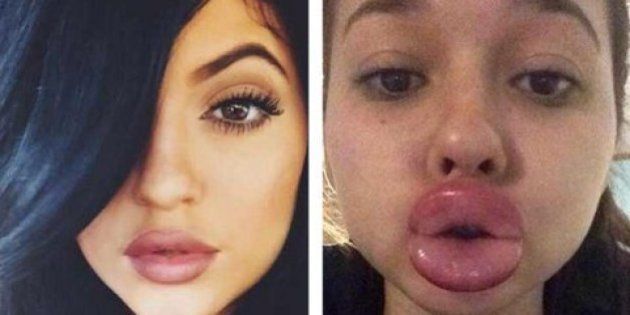 Le Kylie Jenner Challenge ou pourquoi les ados se gonflent les lèvres pour