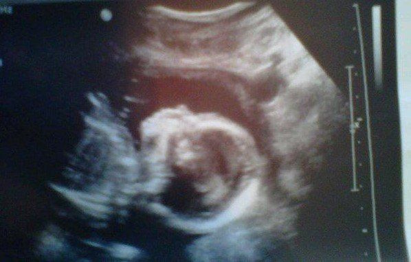 An ultrasound photo of my unborn son, Azlend, taken at 19 weeks on the day his congenital diaphragmatic hernia was discovered.