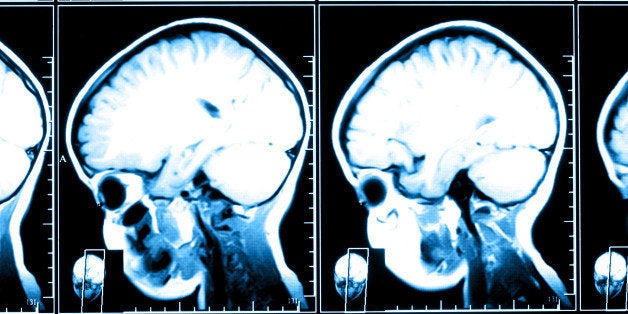 Shock therapy to make a comeback as evidence grows that it works