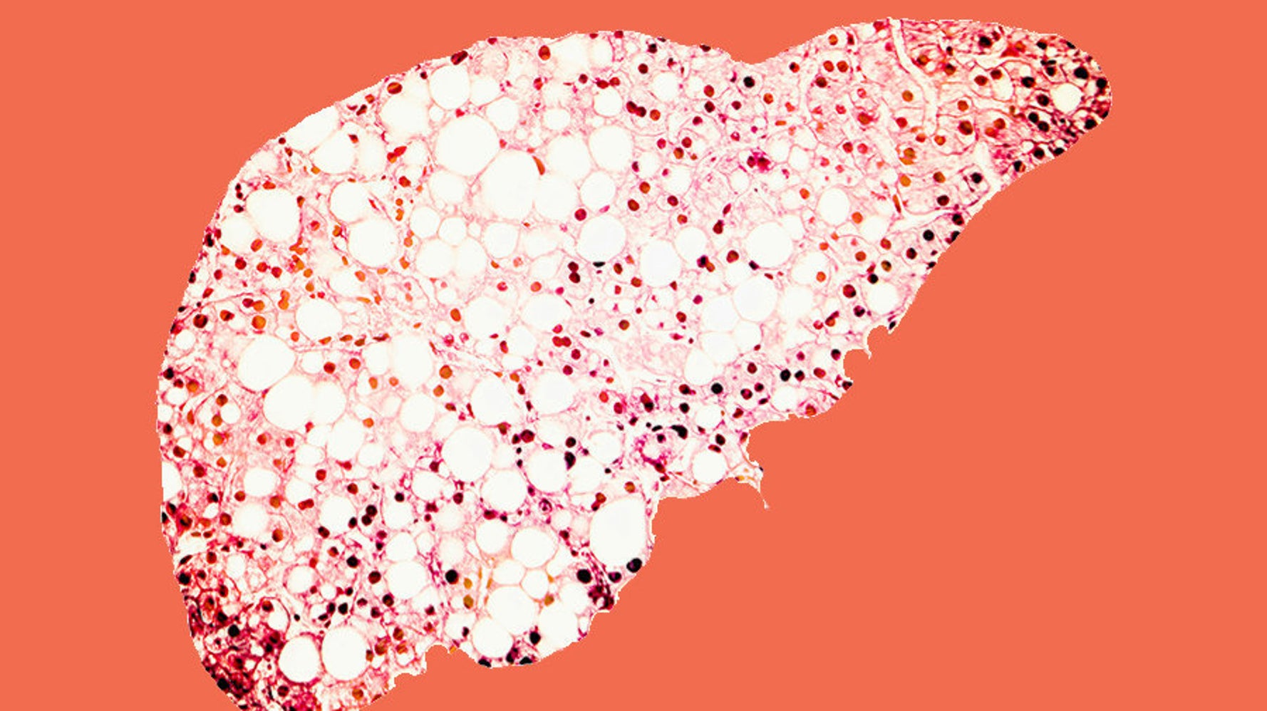 Liver Disease Crisis 1 In 5 Young Brits Showing Signs, Study Says HuffPost UK Life