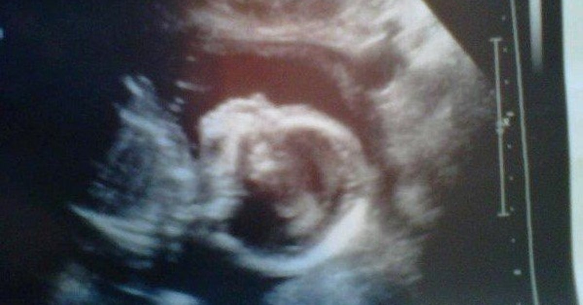 Mi Aborto En La Semana 20 Me Enseno Todo Lo Necesario Sobre Ser